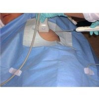 Ultrasound Sterile Biopsy Drape